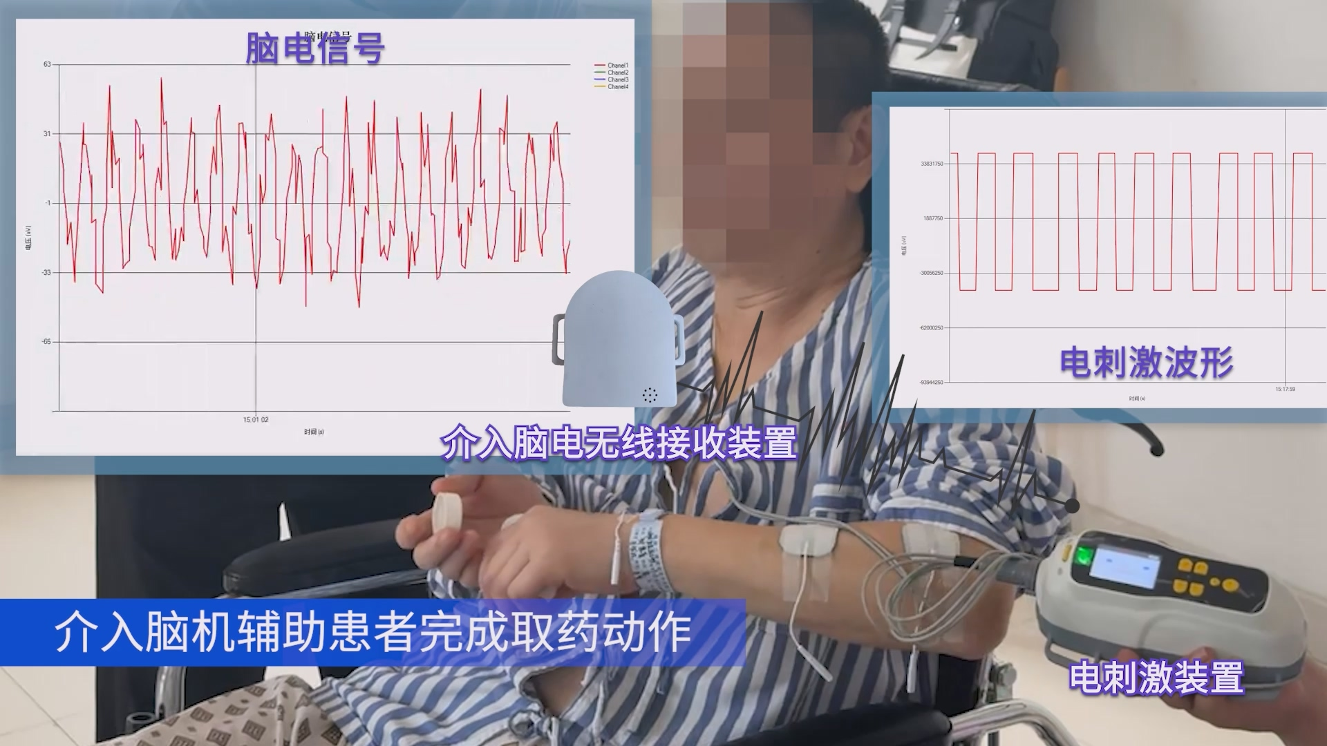 图：全球首例介入式脑机接口辅助人体患肢运动功能修复实验.png