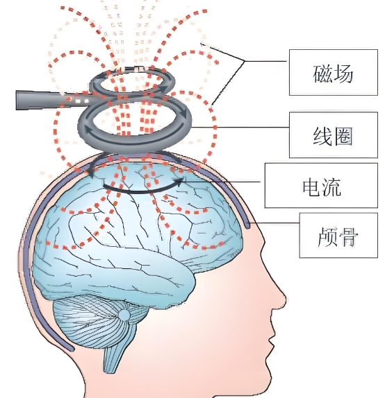 经颅磁.png